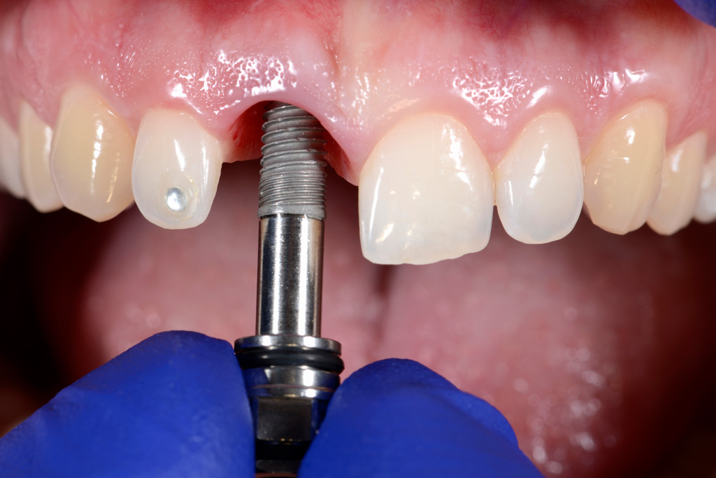 Cosmetic Dentistry - Dental Implants
